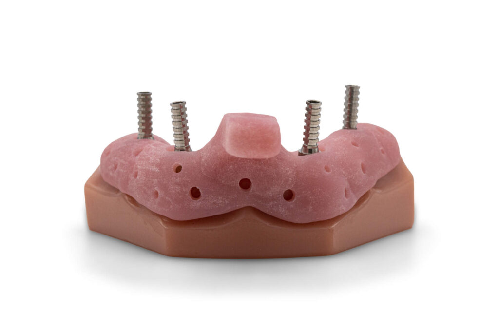 Implant Edentulous Prothesis